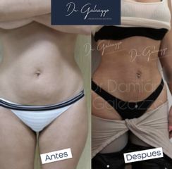Abdominoplastía - Dr. Damián Galeazzo