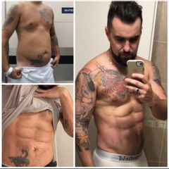 Lipoescultura con Marcación Abdominal - Dr. Damián Galeazzo