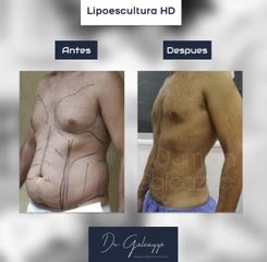 Lipoescultura - Dr. Damián Galeazzo
