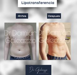 Lipoescultura - Dr. Damián Galeazzo