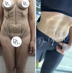 Liposuccion - Damian Galeazzo
