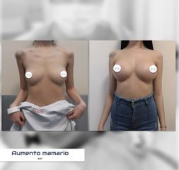 Aumento mamas - Dr. Damián Galeazzo