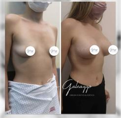 Aumento mamas - Dr. Damián Galeazzo