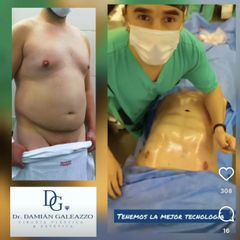 Liposucción - Dr. Damián Galeazzo