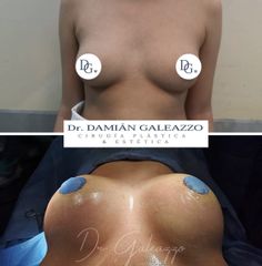 Aumento mamas - Dr. Damián Galeazzo