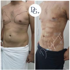 Liposucción - Dr. Damián Galeazzo