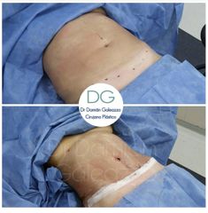 Dermolipectomía - Dr. Damián Galeazzo
