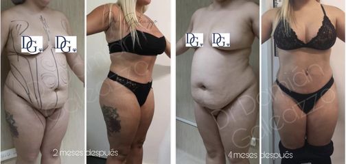 Abdominoplastia - Dr. Damián Galeazzo