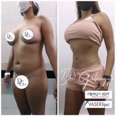Lipoescultura RENUVION-Dr. Damián Galeazzo