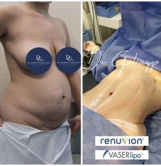 Lipoescultura RENUVION - Dr. Damián Galeazzo