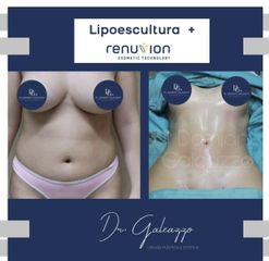 RENUVION JPLASMA- Dr Galeazzo