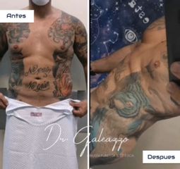 Liposucción - Dr Damián Galeazzo y Equipo