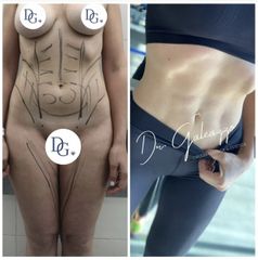 Lipoescultura - Dr Damián Galeazzo y Equipo