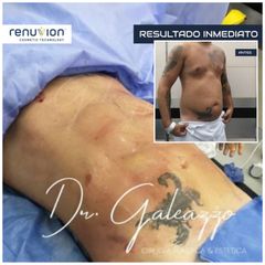Liposucción - Dr Damián Galeazzo y Equipo