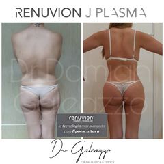 Renuvion J Plasma - Dr Damián Galeazzo y Equipo