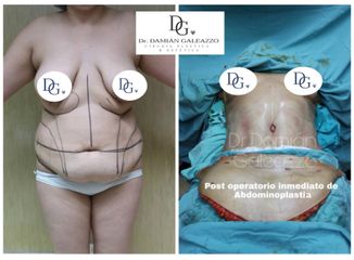 Abdominoplastia - Dr Damian Galeazzo