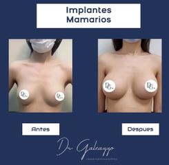 Aumento mamas - Dr Damián Galeazzo y Equipo