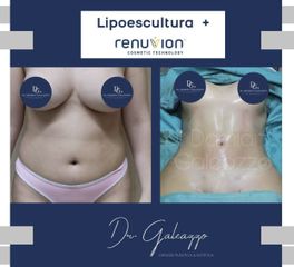 Lipoescultura - Dr Damián Galeazzo y Equipo