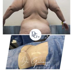 Lipoescultura - Dr Damián Galeazzo y Equipo