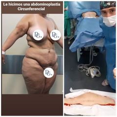 Abdominoplastia - Dr Damián Galeazzo y Equipo