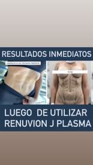 Lipoescultura - Dr Damián Galeazzo y Equipo