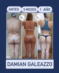 Lipoescultura - Dr Damián Galeazzo y Equipo