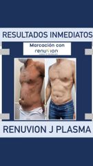 Lipoescultura con RENUVION J PLASMA - Dr Damián Galeazzo y Equipo