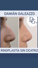 Rinoplastia - Dr Damián Galeazzo y Equipo