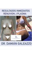 Lipoescultura - Dr Damián Galeazzo y Equipo