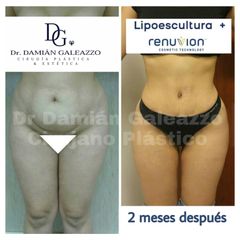 Abdominoplastia - Dr Damián Galeazzo y Equipo