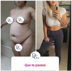 Lipoescultura RENUVION - Dr. Damián Galeazzo y Equipo