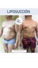 Liposucción - Dr. Damián Galeazzo y Equipo
