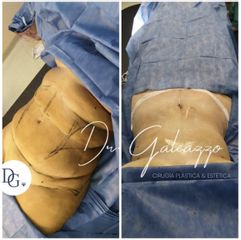 Abdominoplastía 360grados - Dr Galeazzo