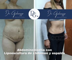 Abdominoplastia - Dr Damián Galeazzo