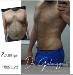 Liposucción - Dr. Damián Galeazzo y Equipo