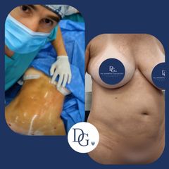 Abdominoplastia - Dr. Damián Galeazzo y Equipo