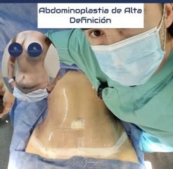 Liposucción - Dr. Damián Galeazzo y Equipo