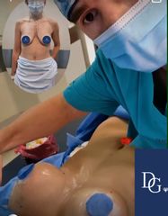 Mastopexia - Dr. Damián Galeazzo y Equipo