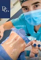 Abdominoplastia - Dr. Damián Galeazzo y Equipo