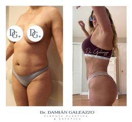 RENUVION JPLASMA - Dr. Damián Galeazzo y Equipo