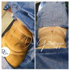 Abdominoplastia Renuvion J plasma - Dr. Damián Galeazzo y Equipo