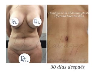 Abdominoplastia Renuvion J plasma - Dr. Damián Galeazzo y Equipo