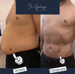 Lipoescultura RENUVION - Dr. Damián Galeazzo y Equipo