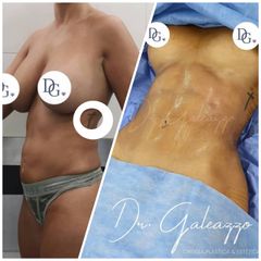 Lipoescultura - Dr. Damián Galeazzo y Equipo