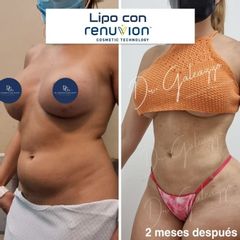 Lipo con RENUVION J PLASMA - Dr. Damián Galeazzo y Equipo