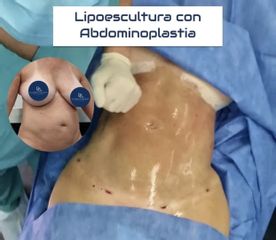 Abdominoplastia - Dr. Damián Galeazzo y Equipo