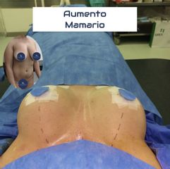 Aumento Mamario - Dr. Damián Galeazzo y Equipo
