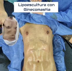 Ginecomastia - Dr. Damián Galeazzo y Equipo