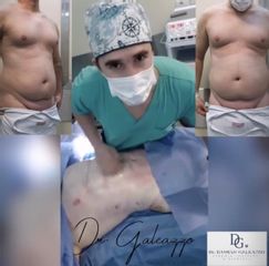 Abdominoplastia - Dr. Damián Galeazzo y Equipo