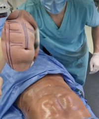 Lipoescultura - Dr. Damián Galeazzo y Equipo